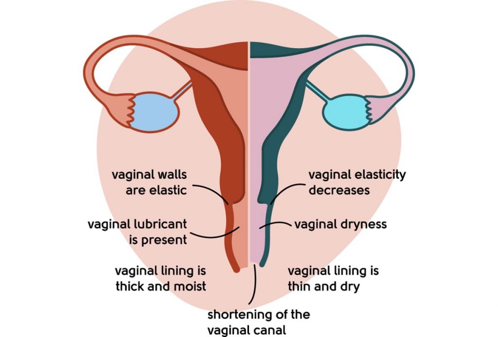 healthy vs atrophy vagina 1024x694 1 - Best Natural Remedies For Vaginal Dryness 2023